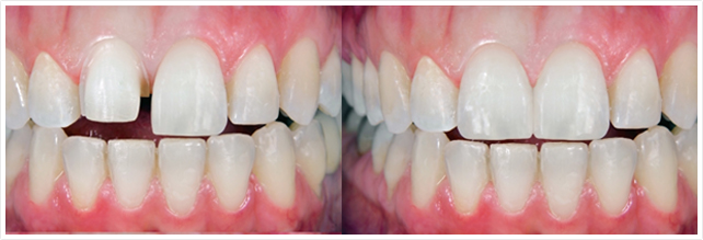 Restorative Dentistry in Plano, TX