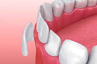 Porcelain Veneers in Plano Illustration