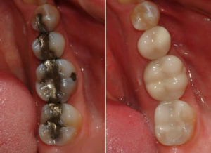 Composite Fillings in Plano, TX